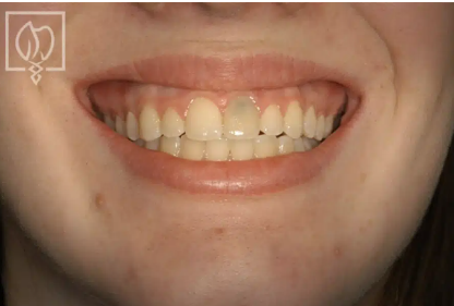 Fig. 1 Before: A Failed Central Incisor Tooth