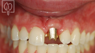 Fig. 3 Emergence Profile Abutment Seated on the Implant
