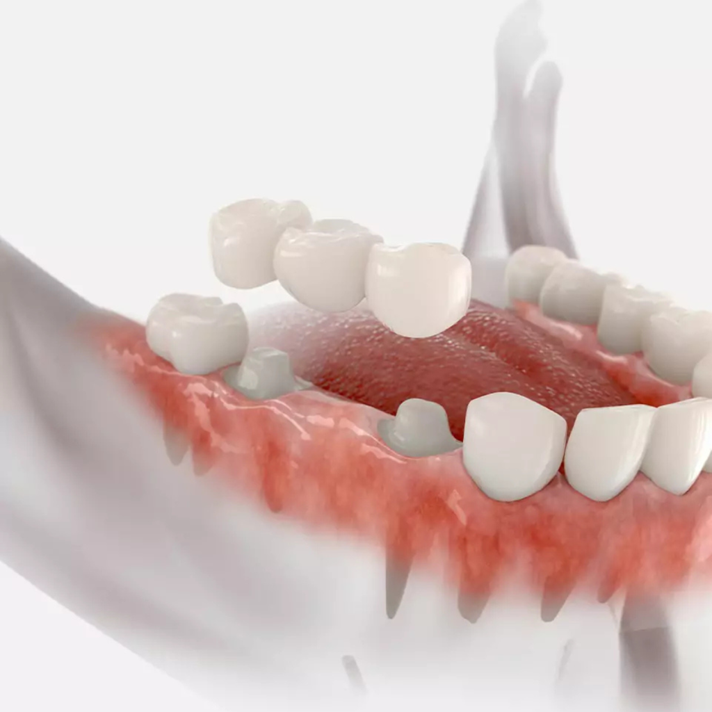 3D illustration of a human mouth with missing teeth, showing gums and remaining teeth, highlighting tooth loss and possible dental issues. Ideal for discussing dental implants in Bethesda or Washington DC.