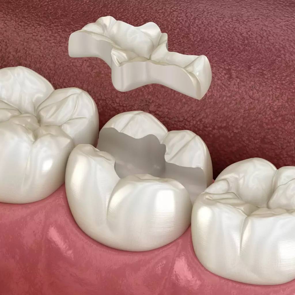 Close-up of custom dental inlay and onlay restorations