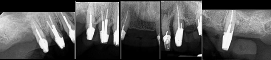 Fig. 1 Failing Teeth Used to Hold a Temporary Splint