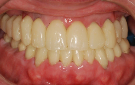 Fig. 2 Stage Ia Temporary Splint