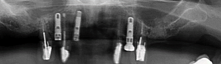 Fig. 3 Stage Ib Three Teeth Extracted and Replaced with Implants
