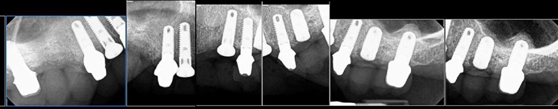 Fig. 4 Stage II Abutments Seated in Implants to Hold Temporary
