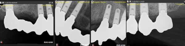 Fig. 5 Stage III All Implants Restored with Permanent Splint