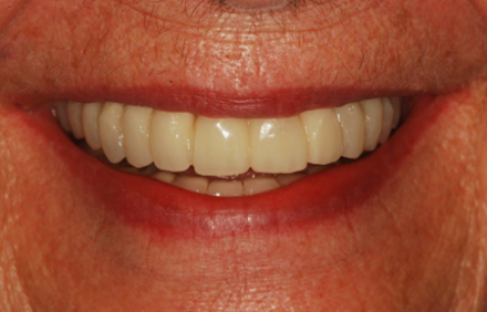 Fig. 6 Final Splint in Place Over Full Arch Implants