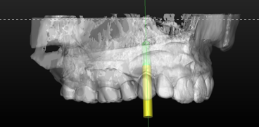 Implant virtually placed on CBCT scan