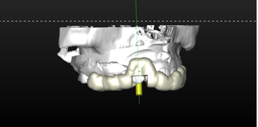 Surgical guide seated on teeth to guide drilling