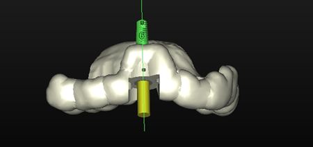 Digital surgical guide dictating implant insertion