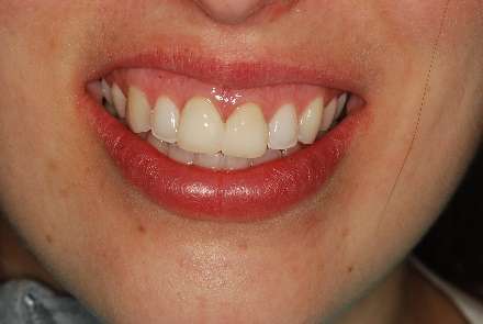 Hand-crafted temporary crowns restoring smile