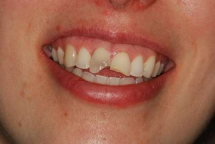 Fractured front teeth after scooter accident