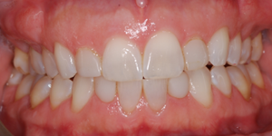 Veneers on lateral incisors that are too short and too dark