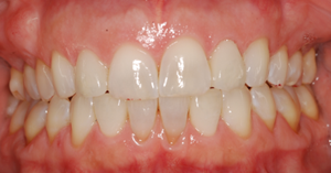 Veneers replaced by crowns with more natural shape and color