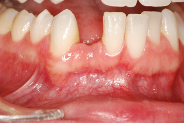 Additional image showing debridement and grafting outcome