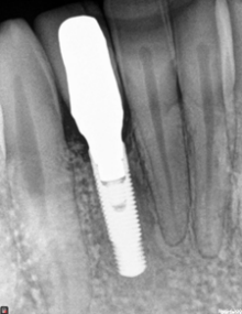 Additional view of the failed implant site and bone condition