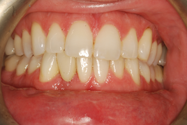 Additional clinical image illustrating ridge defect