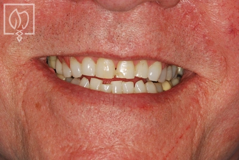 Patient smile during treatment