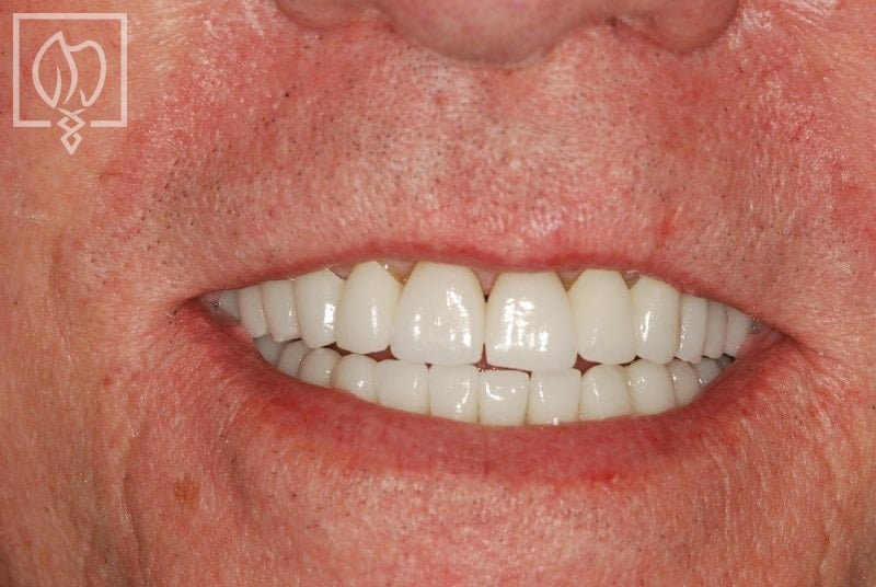 Patient final smile result