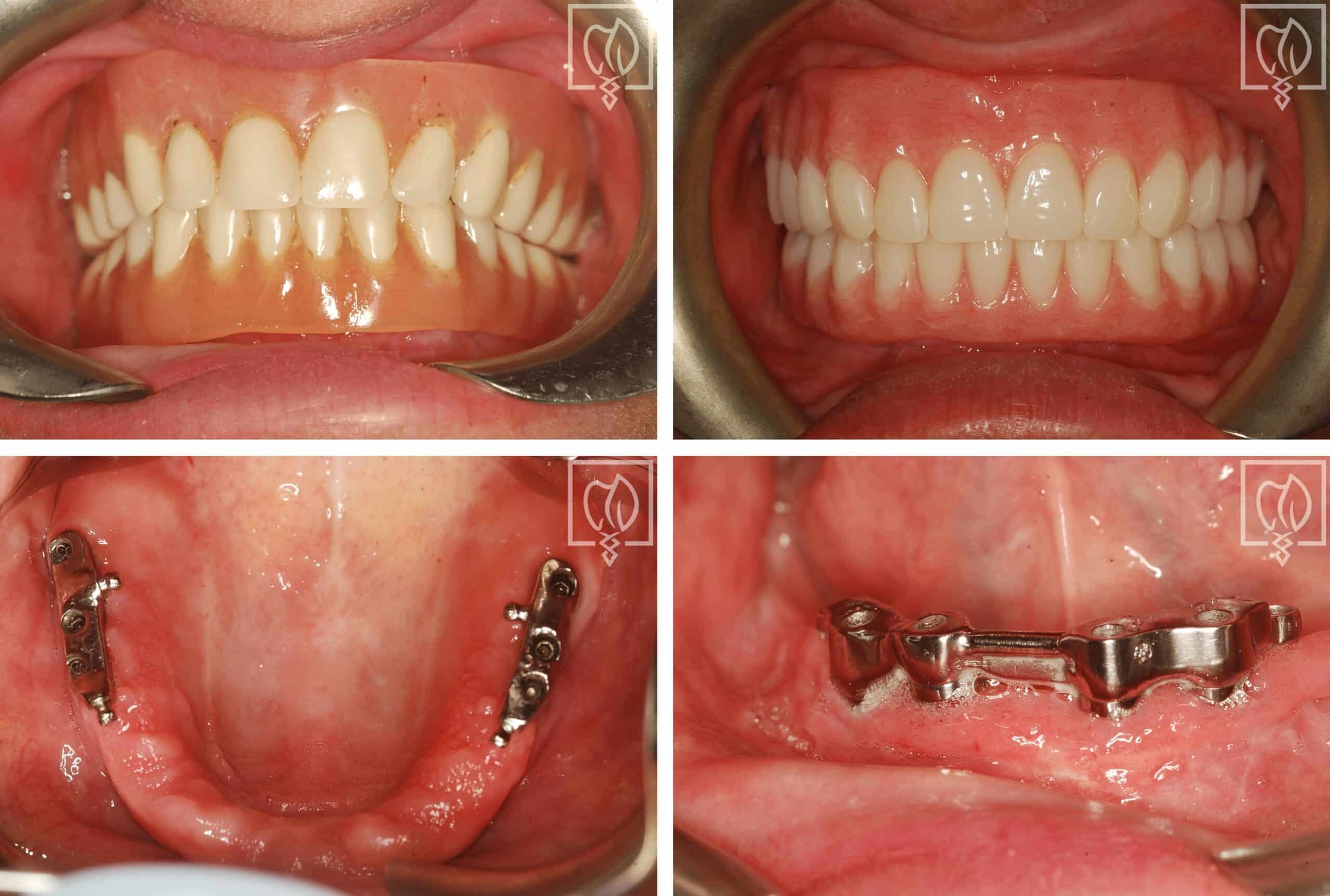 Documented comparison view of the implant overdentures from this case.