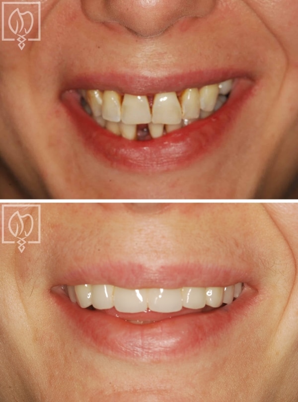 Patient periodontal reconstruction smile before and after
