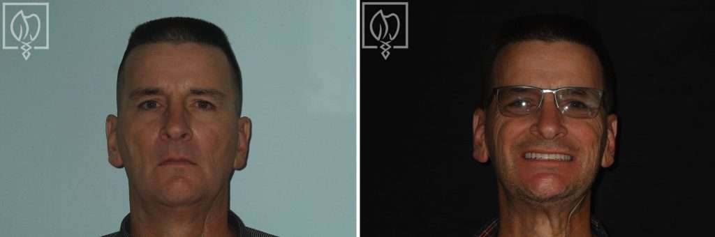Treating Kevin's Collapsed Bite with a Complete Smile Makeover with New Dentures