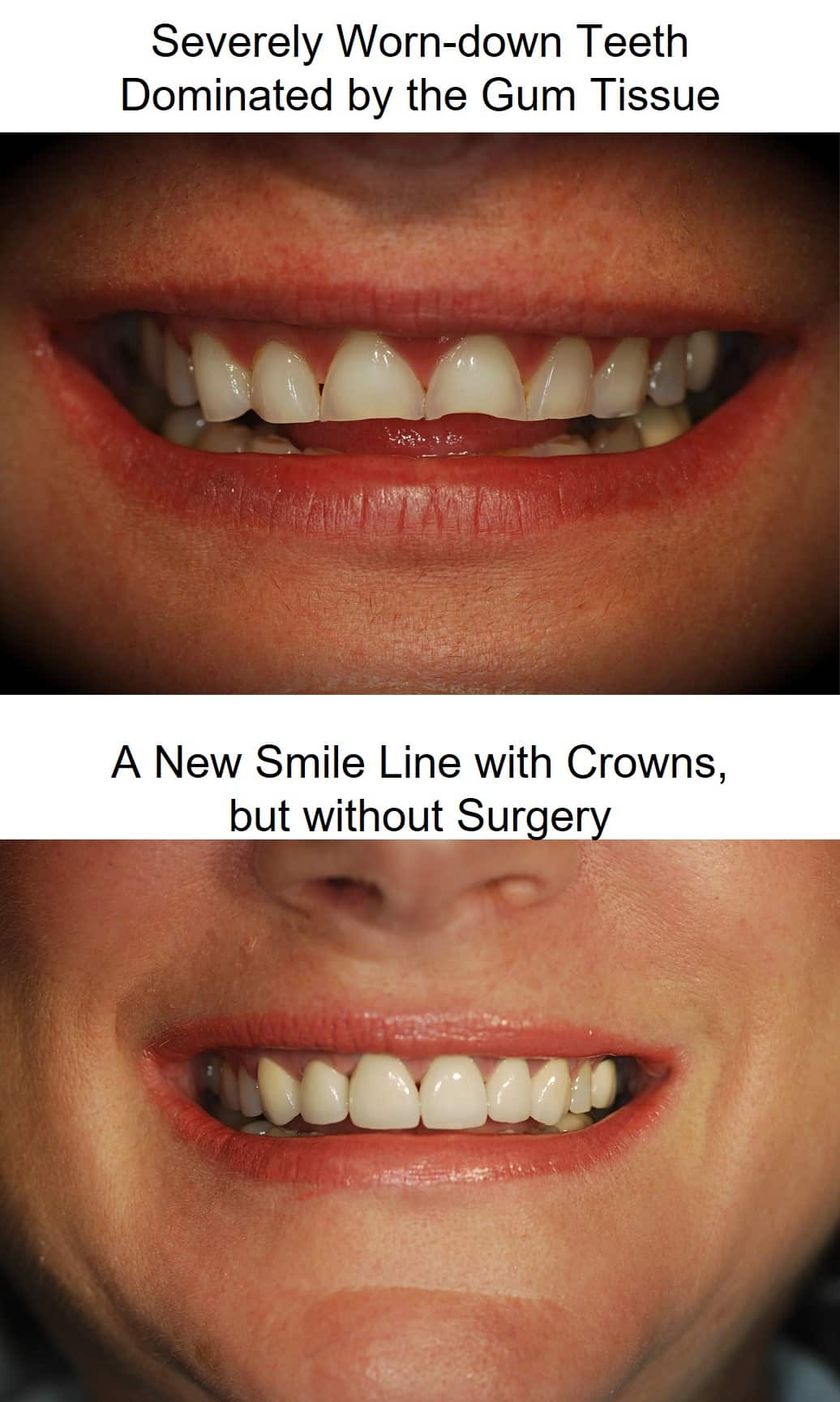 Gum contouring before and after