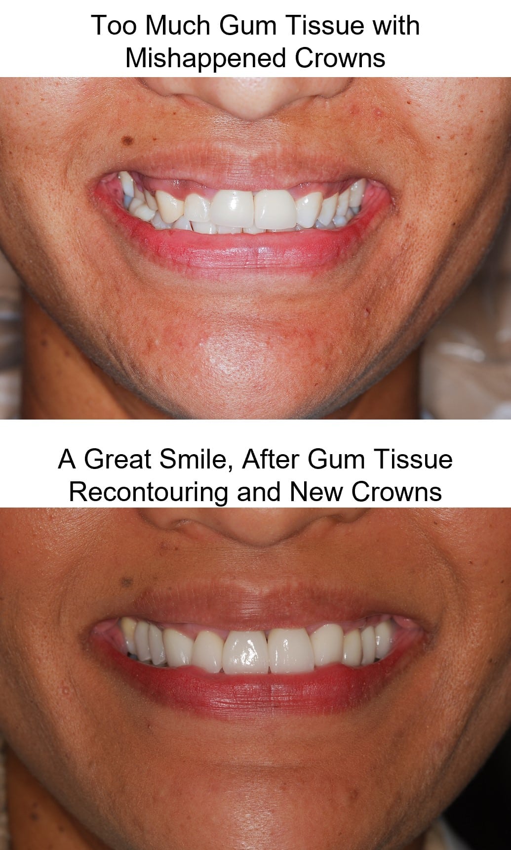Gummy smile correction before and after