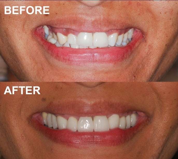 Does Treating or Rehabilitating a Gummy Smile Require Surgery?