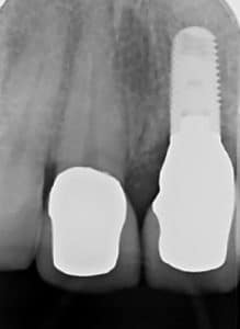 Patient tooth #9 final abutment, crown, and implant restoration