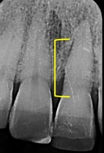 Patient tooth #9 prior to extraction and bone preservation