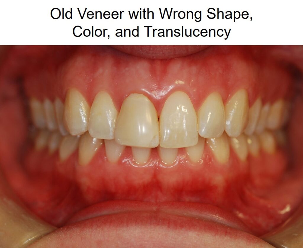 Before: Can Dental Crowns Closely Match My Existing Teeth Color and Shape?