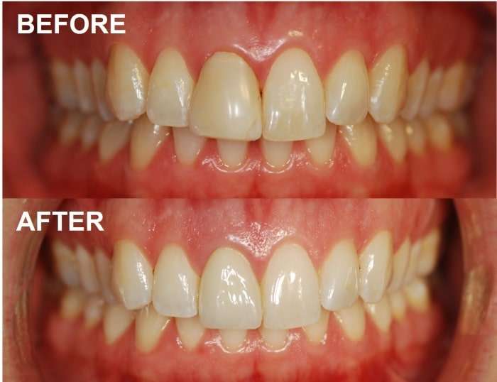 Custom color-matched dental crown result