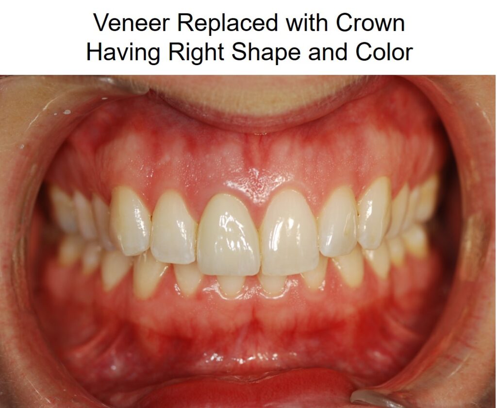 After: Can Dental Crowns Closely Match My Existing Teeth Color and Shape?