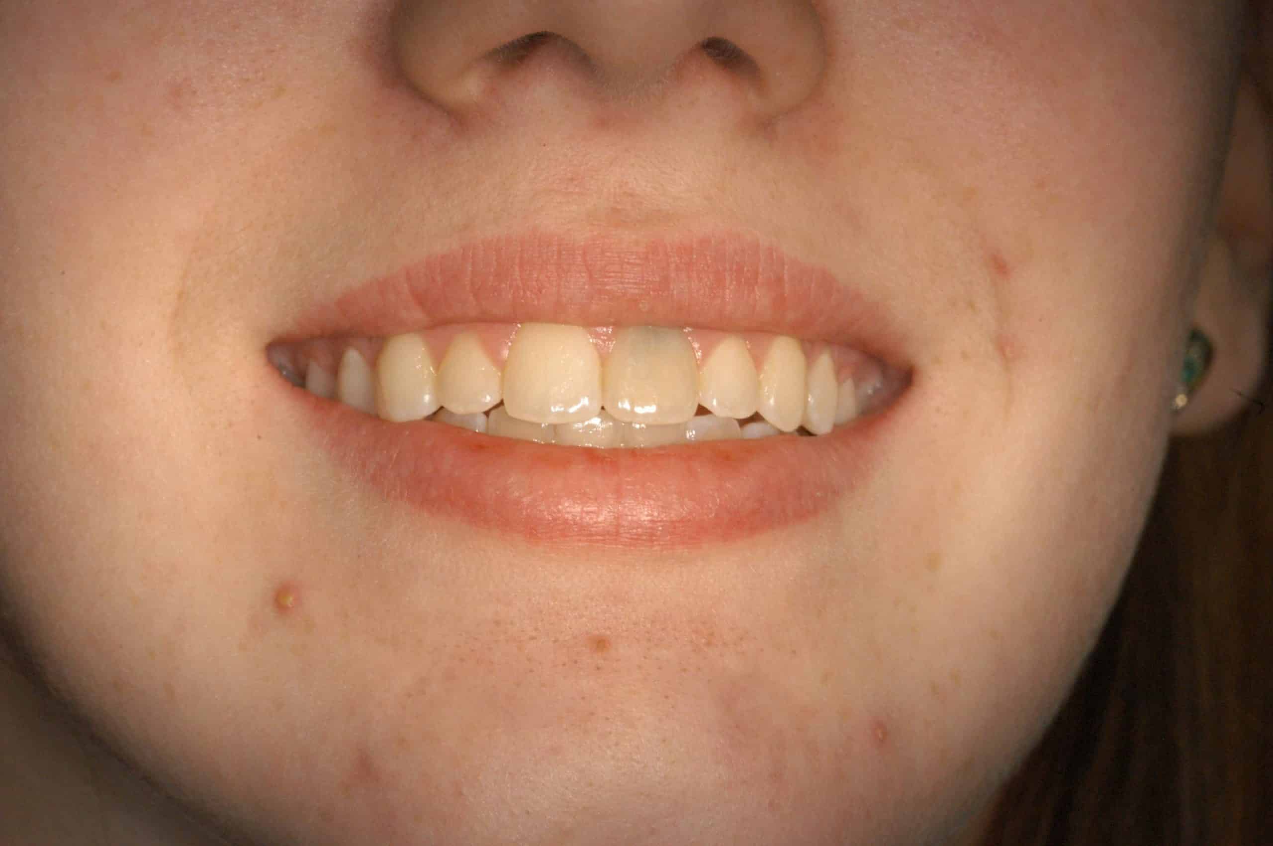 Replacing a Discolored Front Tooth with a Precision Placed Implant