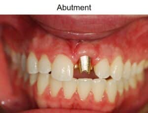 Patient implant abutment placement