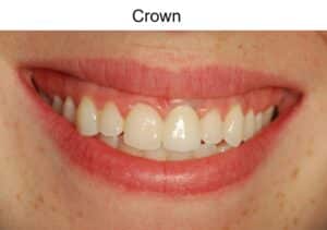 Patient final implant crown restoration