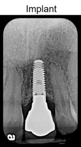 Patient tooth 8 implant restored in 2015